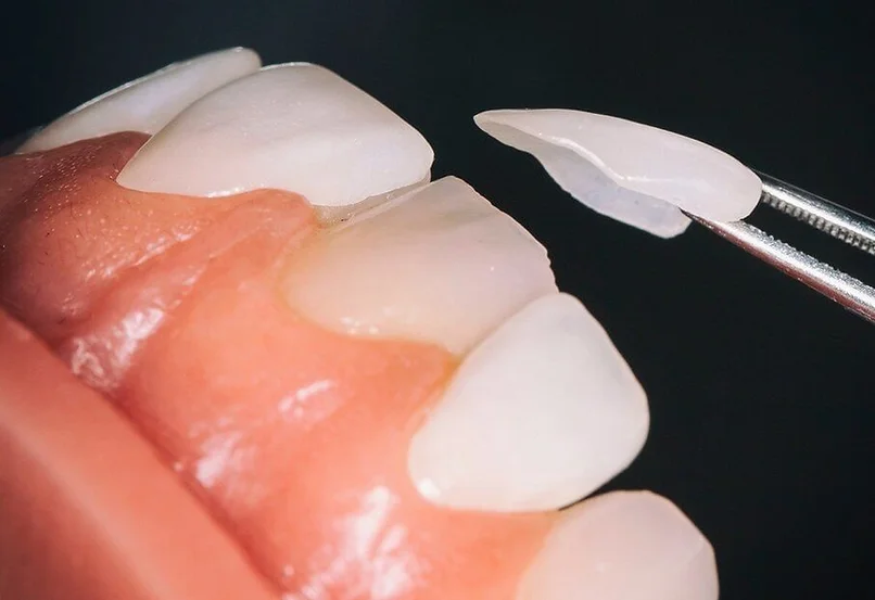 cosmetic-dentistry-white-teeth
