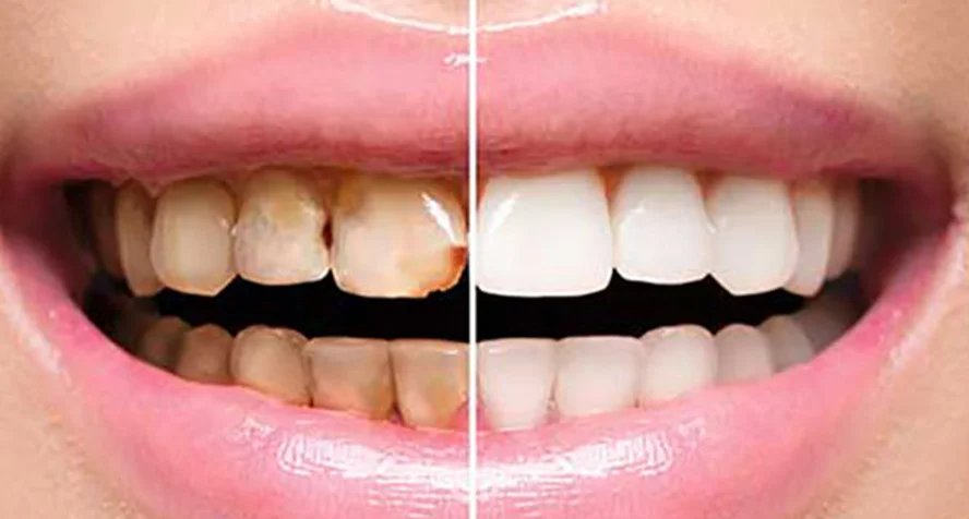 comparison-of-yellowish-teeh-and-white-teeth