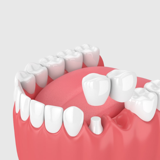 dental-bridges-replace-one-or-more-missing-teeth