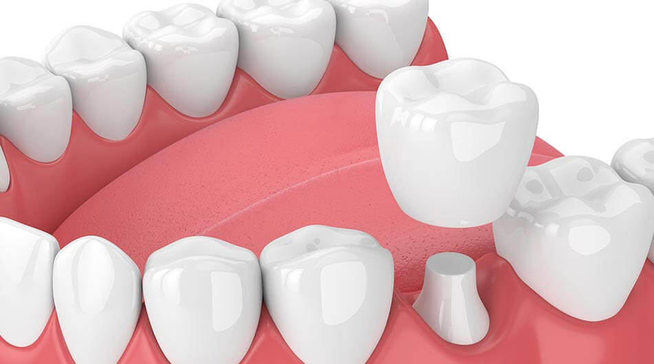 dental-crowns-3d-rendar-image