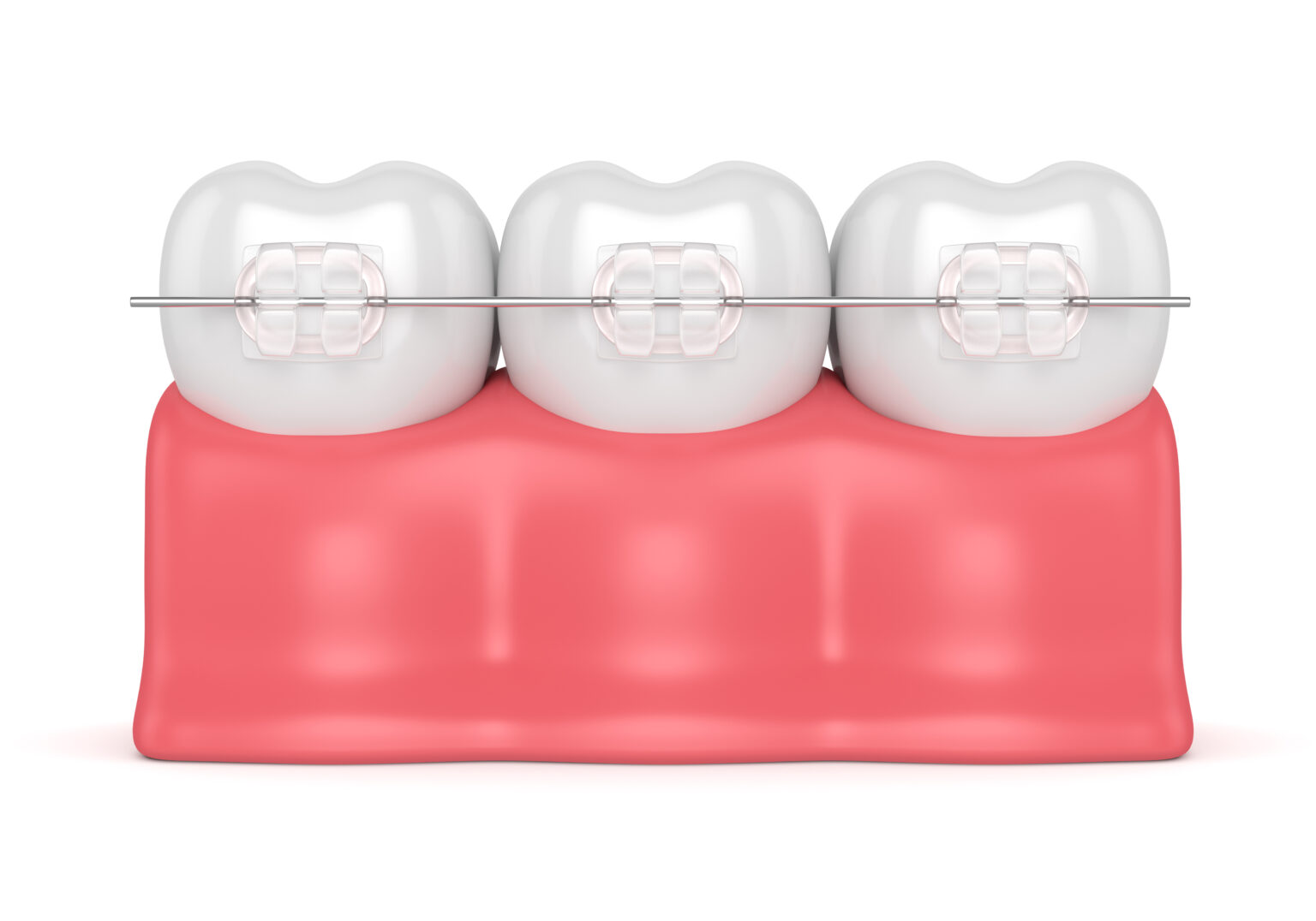 3d-render-of-teeth-with-ceramic-clear-braces