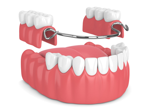 removable-plate-or-frame-holding-one-or-more-artificial-teeth