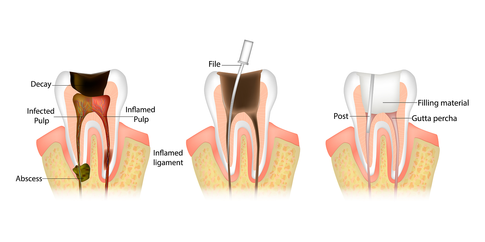 Endodontic-Root-Canal-Treatment-Process