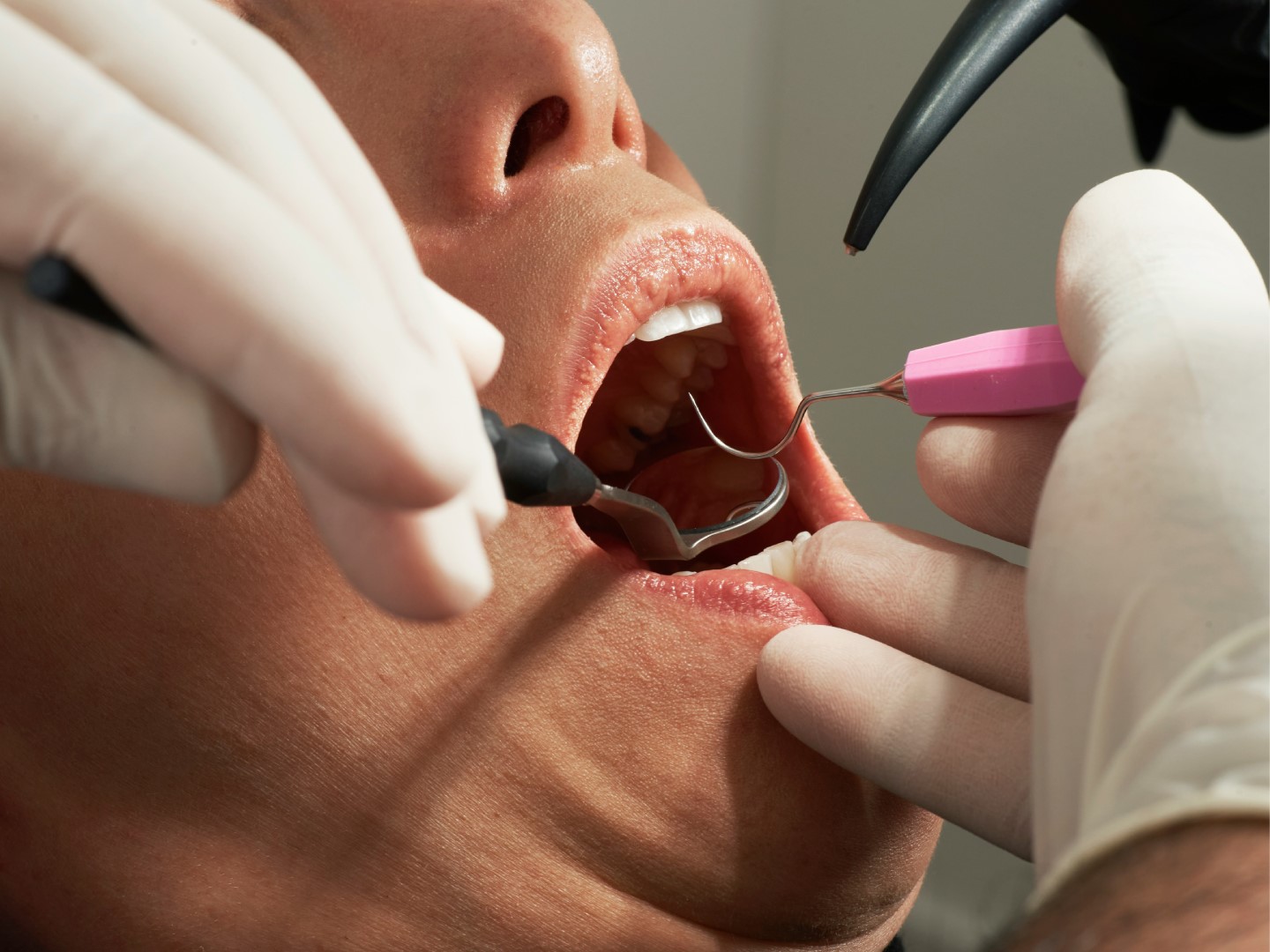 closed-up-of-opened-mouth-to-receive-treatment