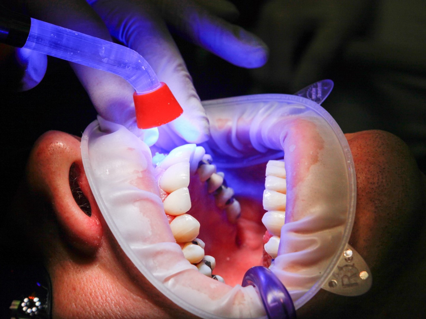 gum-disease-checking-closed-up-on-mouth-with-blue-light